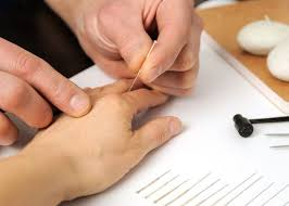 First-Acupuncture