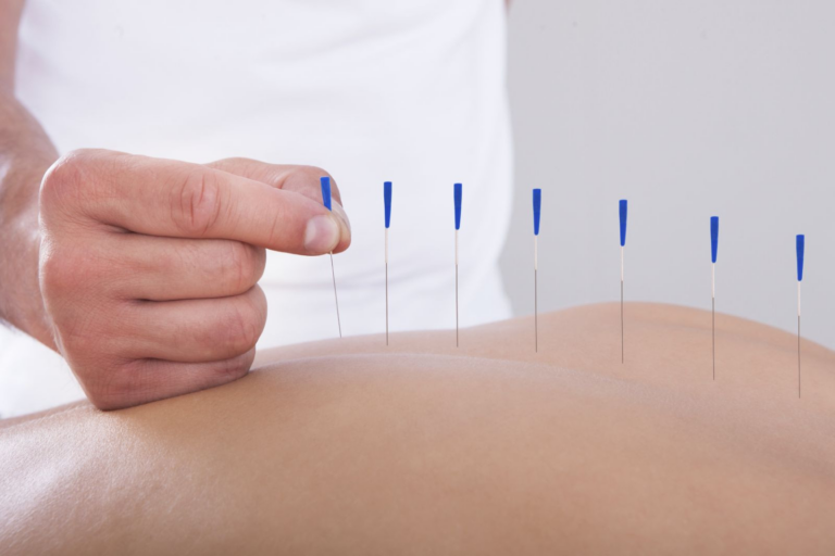 Acupuncture-an-Ancient-Practice