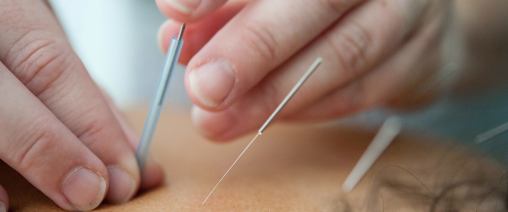 Integrating-Acupuncture